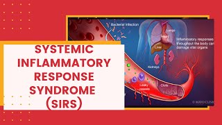 Systemic Inflammatory Response Syndrome SIRS [upl. by Wendi208]