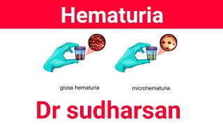 Approach To Hematuria  Types amp Management Dr Sudharsan [upl. by Xonnel]