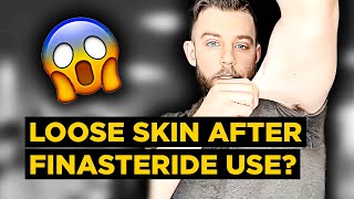 STRANGE Side Effects from PostFinasteride Syndrome Sufferer LOOSE SKIN  Marks PFS Experience [upl. by Gnous]