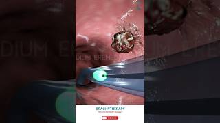 Know About Brachytherapy ↪ 3D Medical Animation Brachytherapy InternalRadiationTherapy [upl. by Ierna]