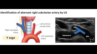 ENGAberrant right subclavian artery [upl. by Accebor379]