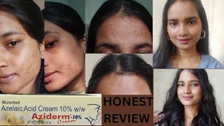 Azelaic Acid Cream 10  Aziderm Cream  Honest Review  Remove Pigmentation  Acne  Dark Sports [upl. by Itsur694]