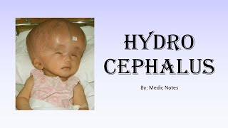 Hydrocephalus  types causes signs and symptoms investigation treatment [upl. by Fornof]