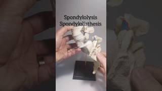 Spondylolysis Spondylolisthesis Dynamic Disc Designs Model [upl. by Ttsepmet]