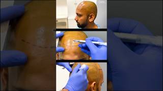 Ideal Hairline in Hair Transplant [upl. by Eveam]