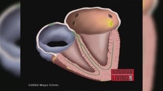 The Mayo Clinic explains how to treat Atrial Fibrillation [upl. by Sandell709]