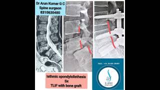 listhesis outcome [upl. by Ecirtam]