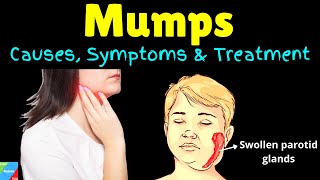 Mumps Symptoms Causes Treatments and Complications [upl. by Sirkin375]