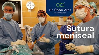 Sutura Meniscal  Dr Oscar Ares [upl. by Nyleahcim]