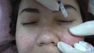 Acne Steroid Injection  Dr Ho Rui Ming Singapore [upl. by Stolzer]