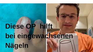 Hilfe bei eingewachsenen Zehenägeln [upl. by Aillil415]