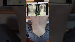 Scoliosis at Mobility MedClinic Toronto 🇨🇦 afrobeat love afrobeats scoliosiswarrior [upl. by Eillah]