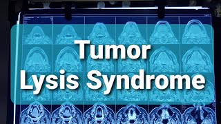 Tumor Lysis Syndrome [upl. by Vijnas]