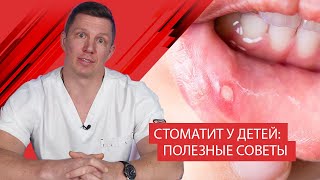 Стоматит у детей полезные советы [upl. by Imena]