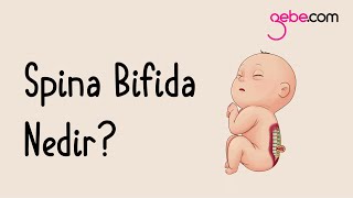 Spina Bifida Nedir Spina Bifida Ameliyatı Nasıl Yapılır [upl. by Dambro]