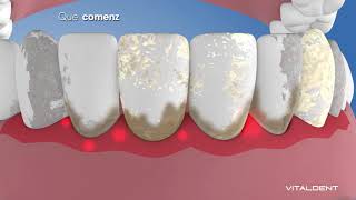 Periodoncia  Vitaldent [upl. by Enelrihs]