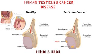 HUMAN TESTICLES CANCER A Guide to Testicular Cancer Diagnosis and Treatment HINDI amp URDU [upl. by Vasilek]