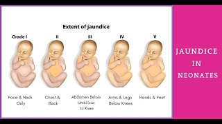 Jaundice Symptoms Types Causes amp Treatment amplemedicallectures [upl. by Atil124]