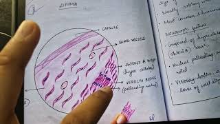 schwannoma histopathology gross and microscopic features [upl. by Ehsiom]