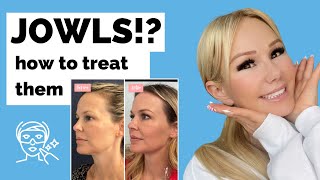 JOWLS How to treat them without surgery Thermafrax thread lifts fillers botox more [upl. by Imeon]