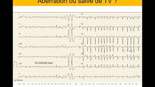 Tachycardie ventriculaire ou supraventriculaire  Quiz ECG Dr Taboulet [upl. by Esaertal]