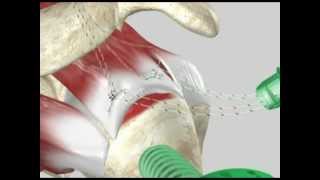 Arthroscopic Rotator Cuff Repair [upl. by Kilam]