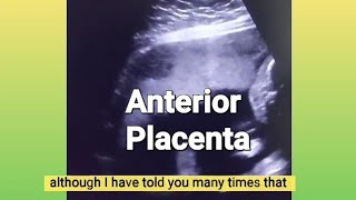 Anterior placenta baby gender  12 weeks Twin pregnancy  3 vessel cord or turtle sign  ultrasound [upl. by Colville]