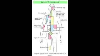 Virchows Node Abdominal Metastasis [upl. by Bainbrudge]