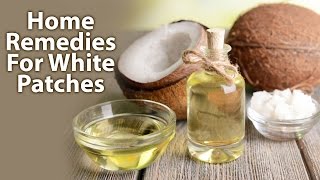 Home Remedies For White PatchesLeucoderma [upl. by Devina]