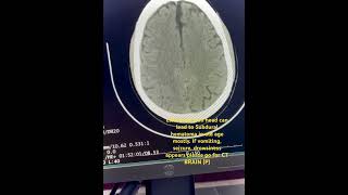 Subdural Hematoma SDH  slight head injury can lead hemorrhage hemorrhage headinjury ctbrain [upl. by Annabell]