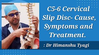 C5  C6 Cervical Slip Disc Cause Symptoms and Treatment [upl. by Gnivri821]