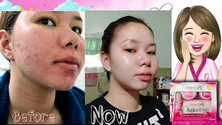 15 Days Using BRILLIANT SKIN ESSENTIAL ✅ REJUVENATING SET REVIEW [upl. by Paolina794]