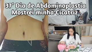 37° dia de Abdominoplastia  Mostrei minha Cicatriz [upl. by Griswold]