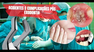 Complicações e Acidentes Pós Operatórios em Odontologia [upl. by Georgette971]