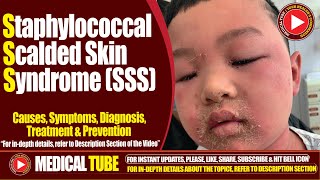 Staphylococcal Scalded Skin Syndrome SSS  Causes Symptoms Treatment  Lancet Infectious Diseases [upl. by Introc661]