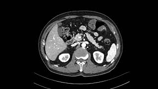 GB adenomyomatosis [upl. by Tekla]