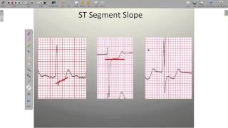 Effects of Ischemia on the ECG [upl. by Liss]