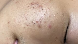 ACNE TREATMENT VU QUYNH MI Blackheads On Boy Face 2024 [upl. by Franci]