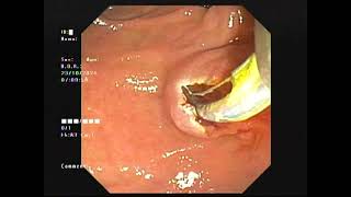 ERCPCBD CALCULIPOST SPHINCTEROTOMY BLEEDBALLON TAMPONADE [upl. by Deck96]