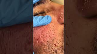 Treatment of firstdegree sensitive skin and how to treat it blackheads skincare skincareroutine [upl. by Amla]