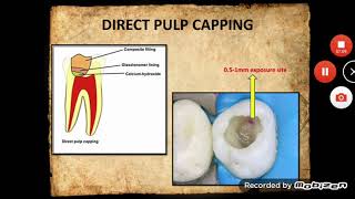 VITAL PULP THERAPY amp BLEACHING [upl. by Dino]