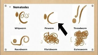 Pinworms Threadworm Infection [upl. by Bela]