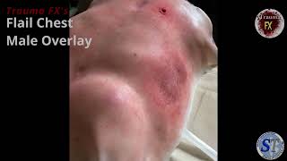 Trauma FX Flail Chest Video [upl. by Busey573]