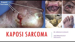 KAPOSI SARCOMA EXPLAINED BY DR ABRAHAM educational viralvideo lecture dermatology [upl. by Nirot669]