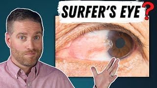 Surfers Eye  Pterygium Explained Growth On Your Eye [upl. by Aihseuqal602]