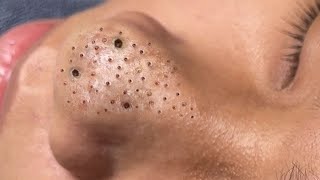 Big Cystic Acne Blackheads Extraction Blackheads amp Milia Whiteheads Removal Pimple Popping  396 [upl. by Samy]