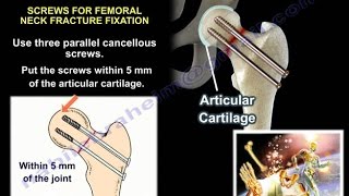 Hip Fractures  Everything You Need To Know  Dr Nabil Ebraheim [upl. by Enneillij]