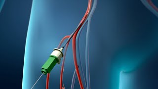 Coronary Angioplasty Femoral Access [upl. by Reldnahc785]