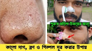 ব্ল্যাকহেডস এবং হোয়াইটহেডস গুড়া থেকে তুলে ফেলুন  How to Remove Blackheads From Nose amp Face [upl. by Nodaj499]