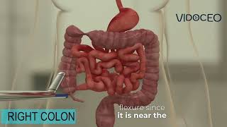 Laparoscopic right hemicolectomy with subtitles [upl. by Guenzi]